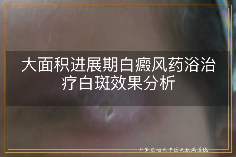 大面积进展期白癜风药浴治疗白斑效果分析