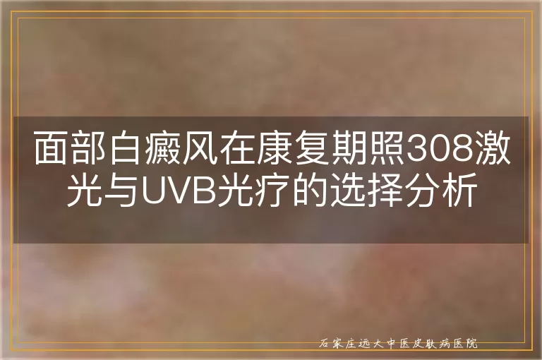 面部白癜风在康复期照308激光与UVB光疗的选择分析