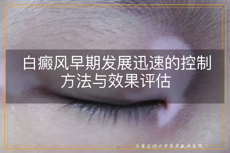 白癜风早期发展迅速的控制方法与效果评估