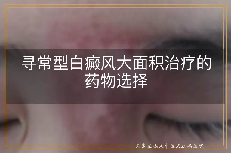 寻常型白癜风大面积治疗的药物选择