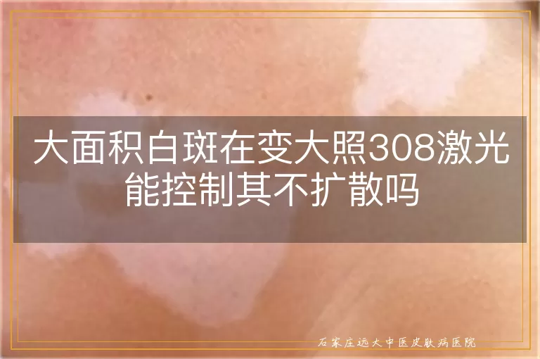 大面积白斑在变大照308激光能控制其不扩散吗
