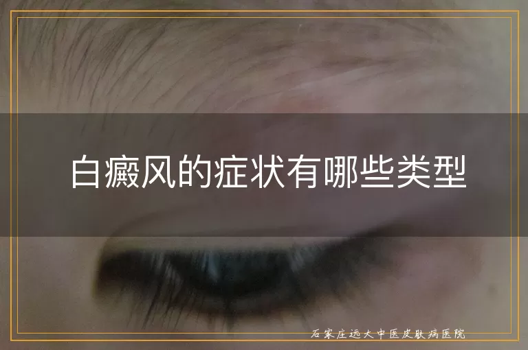白癜风的症状有哪些类型