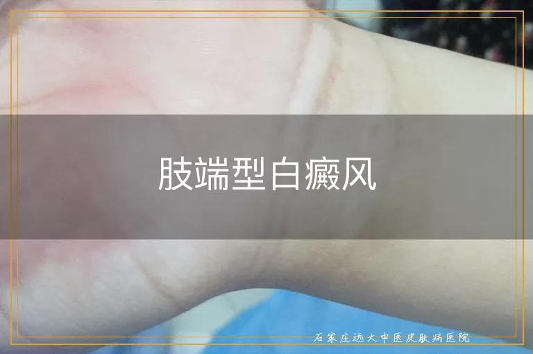 肢端型白癜风