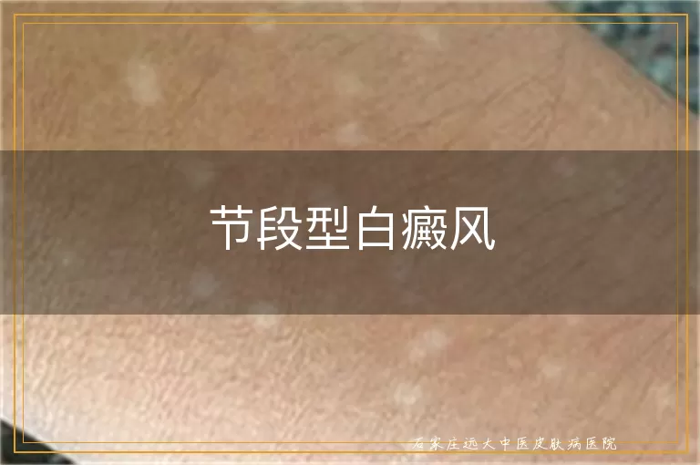 节段型白癜风