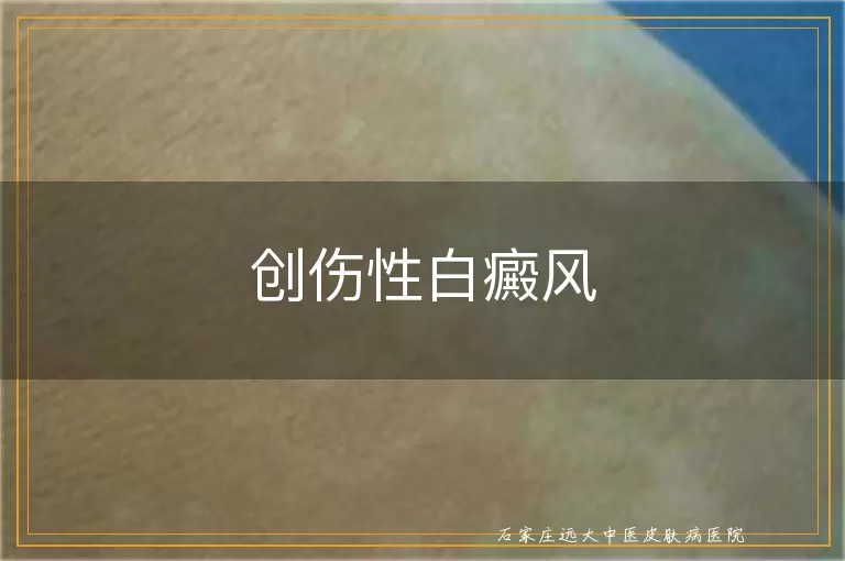 创伤性白癜风