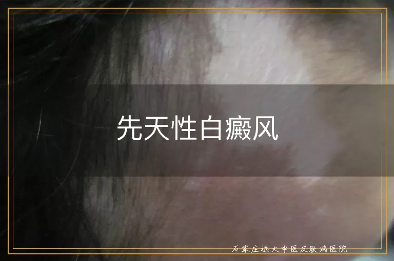 先天性白癜风