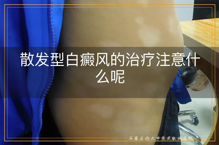 散发型白癜风的治疗注意什么呢