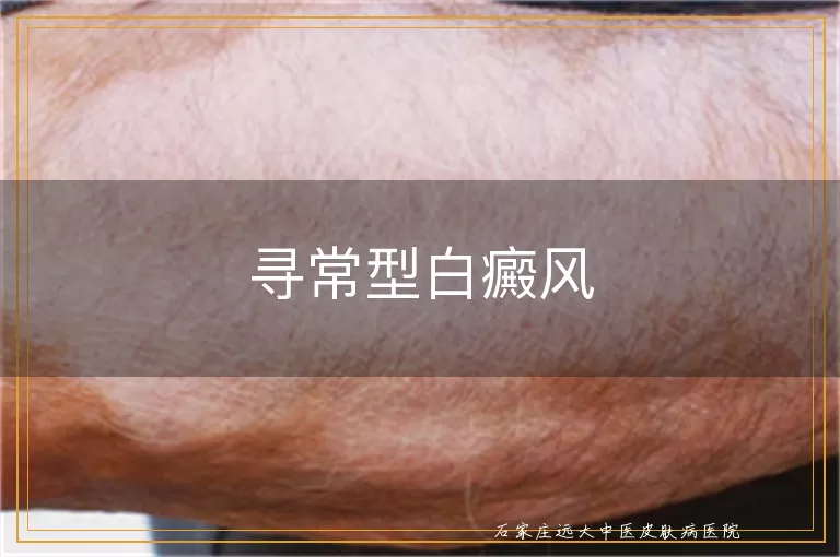 寻常型白癜风