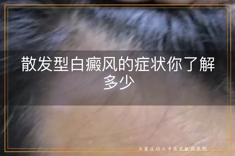 散发型白癜风的症状你了解多少