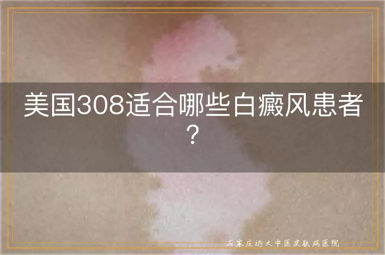 美国308适合哪些白癜风患者？