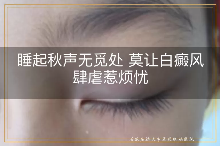 睡起秋声无觅处 莫让白癜风肆虐惹烦忧