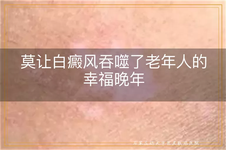莫让白癜风吞噬了老年人的幸福晚年