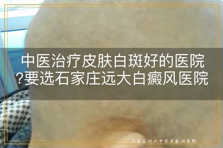 中医治疗皮肤白斑好的医院?要选石家庄远大白癜风医院