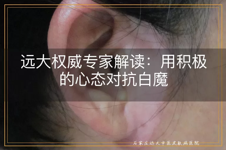 远大权威专家解读：用积极的心态对抗白魔