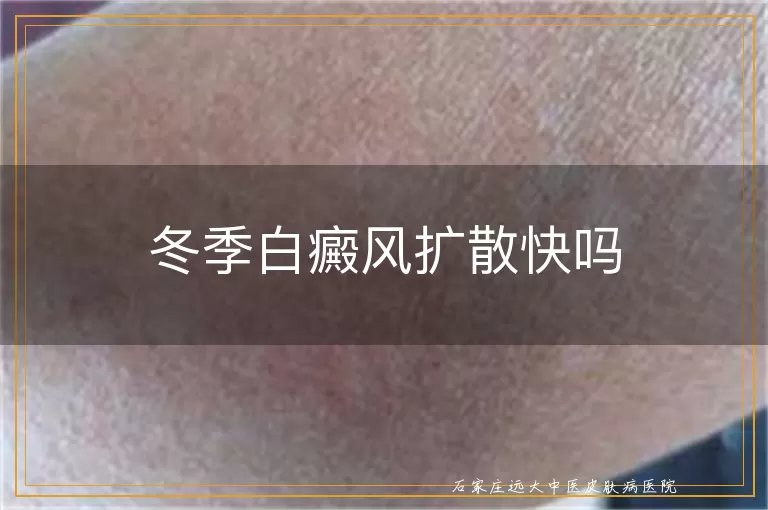 冬季白癜风扩散快吗