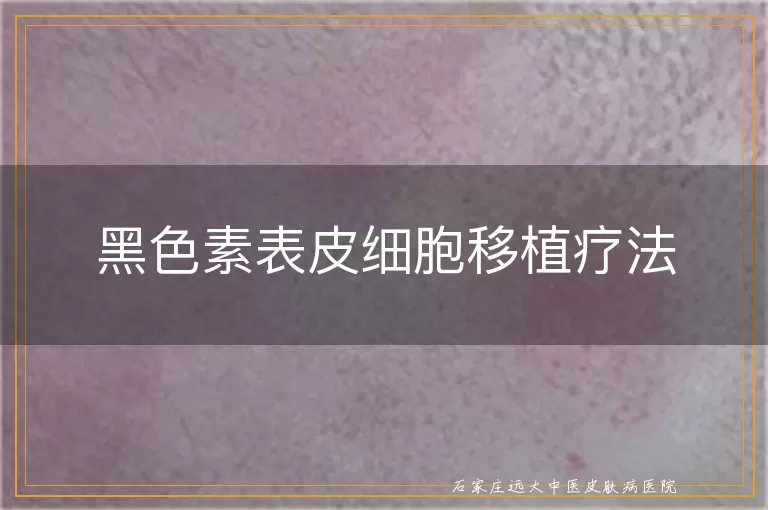 黑色素表皮细胞移植疗法