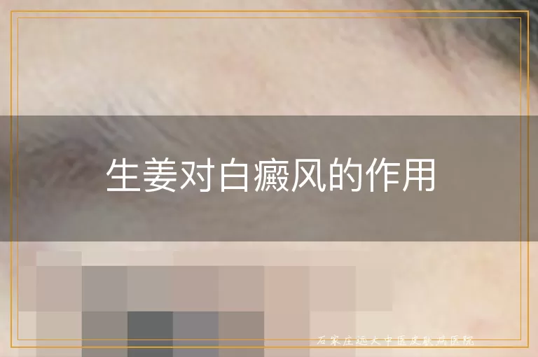 生姜对白癜风的作用