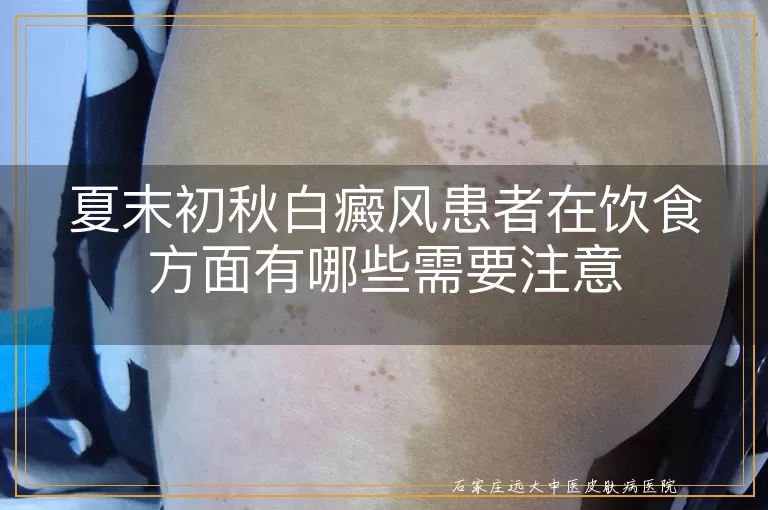 夏末初秋白癜风患者在饮食方面有哪些需要注意