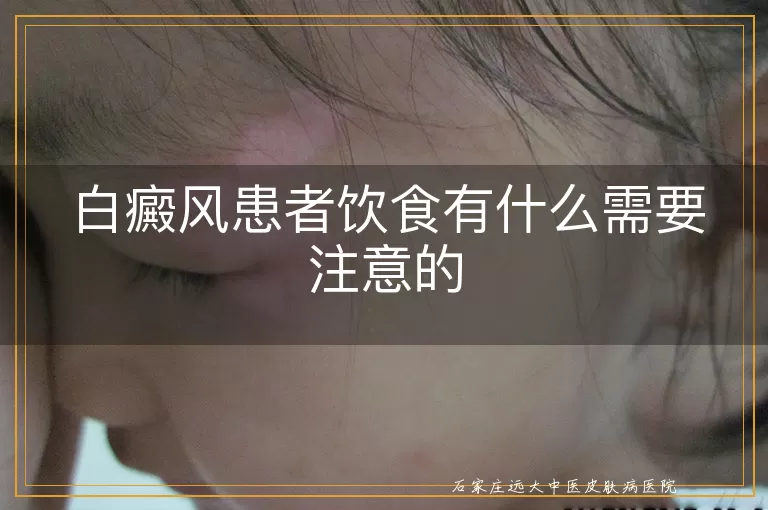 白癜风患者饮食有什么需要注意的