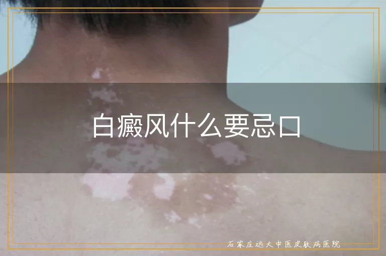 白癜风什么要忌口