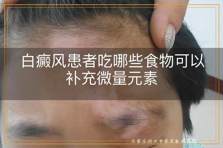白癜风患者吃哪些食物可以补充微量元素
