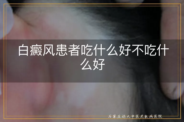 白癜风患者吃什么好不吃什么好