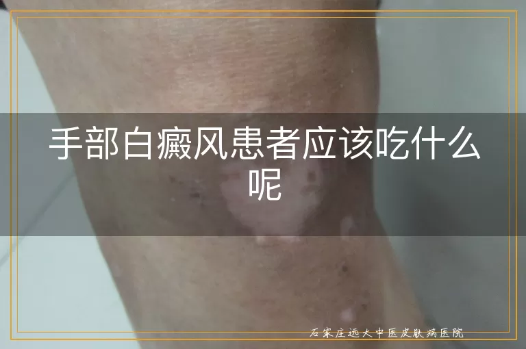 手部白癜风患者应该吃什么呢