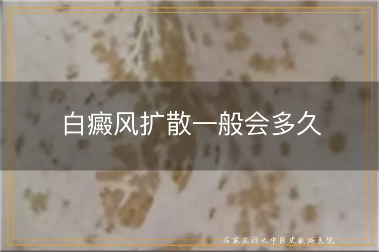 白癜风扩散一般会多久
