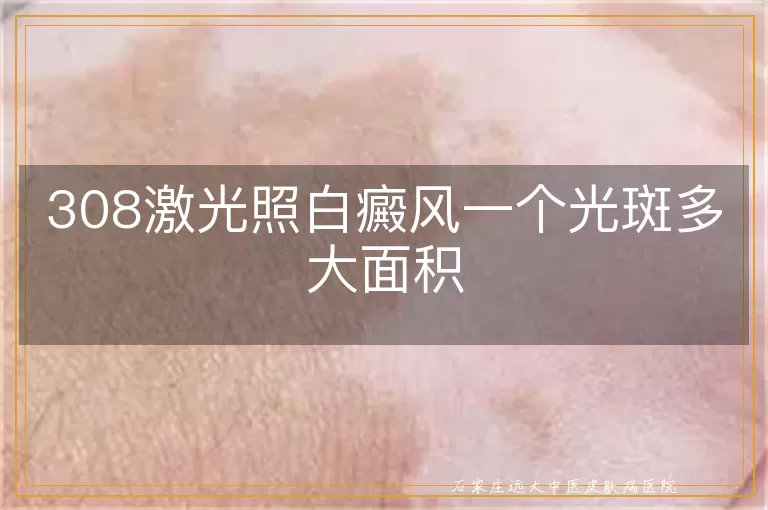 308激光照白癜风一个光斑多大面积