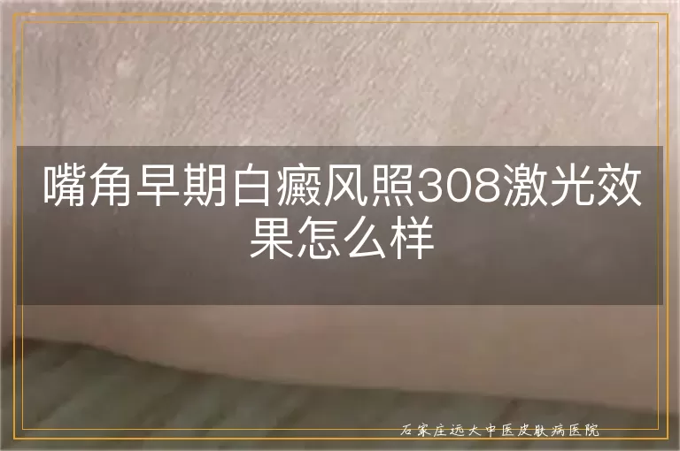 嘴角早期白癜风照308激光效果怎么样
