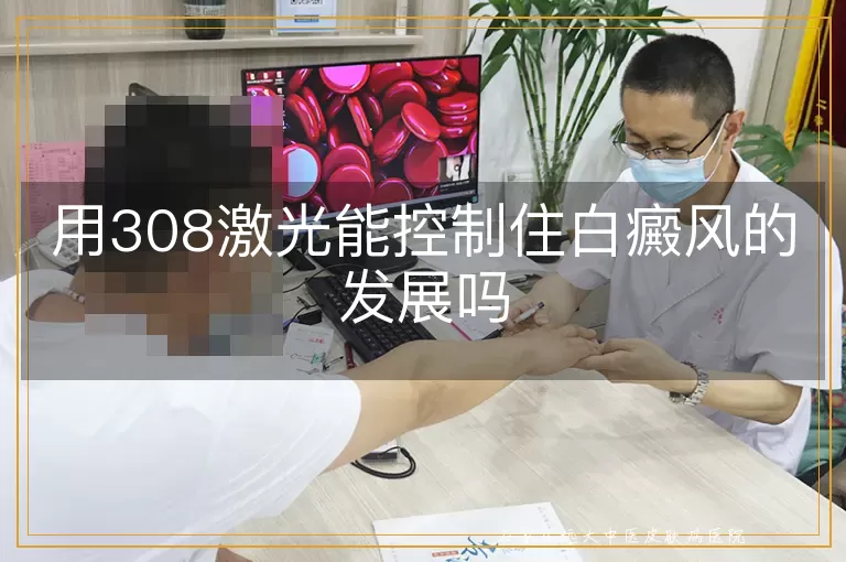 用308激光能控制住白癜风的发展吗