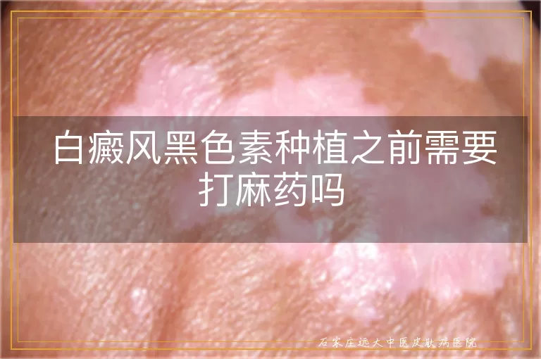 白癜风黑色素种植之前需要打麻药吗