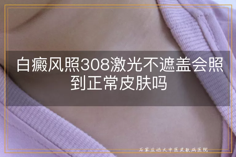 白癜风照308激光不遮盖会照到正常皮肤吗