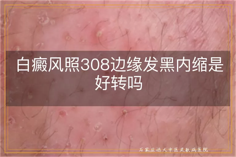 白癜风照308边缘发黑内缩是好转吗