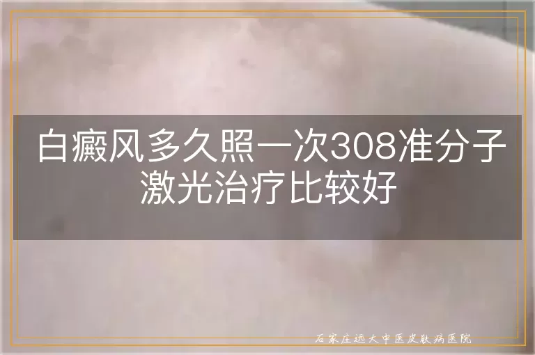 白癜风多久照一次308准分子激光治疗比较好