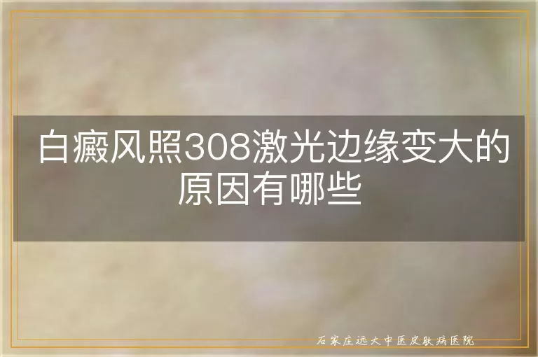 白癜风照308激光边缘变大的原因有哪些