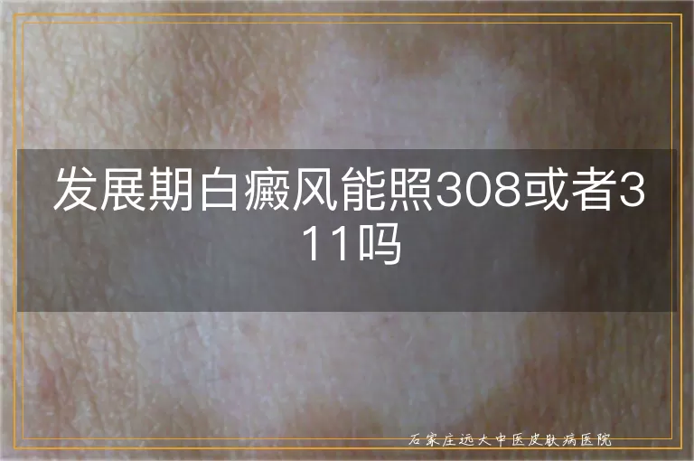 发展期白癜风能照308或者311吗