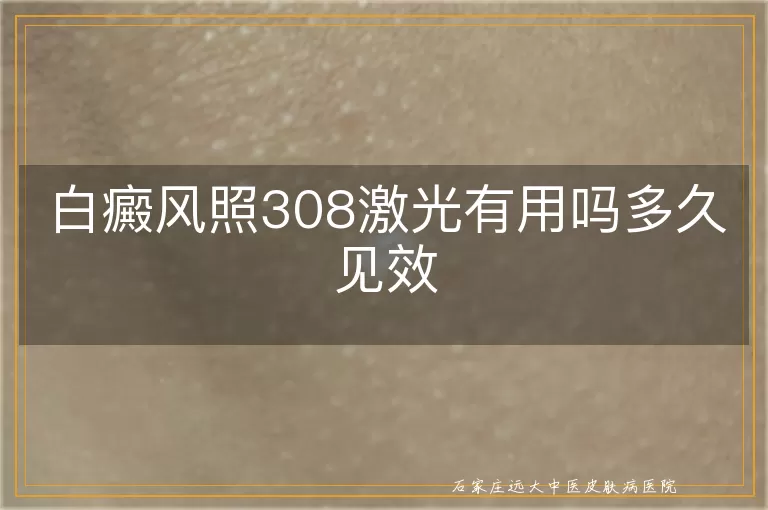 白癜风照308激光有用吗多久见效