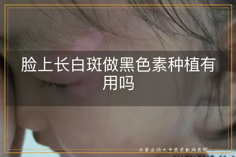 脸上长白斑做黑色素种植有用吗