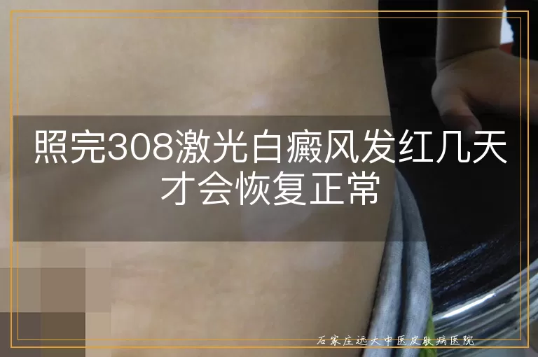 照完308激光白癜风发红几天才会恢复正常