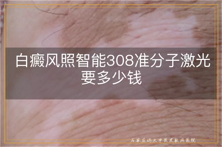 白癜风照智能308准分子激光要多少钱