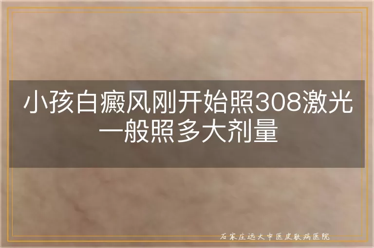 小孩白癜风刚开始照308激光一般照多大剂量