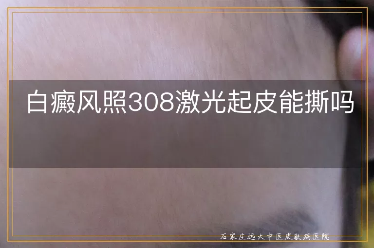 白癜风照308激光起皮能撕吗