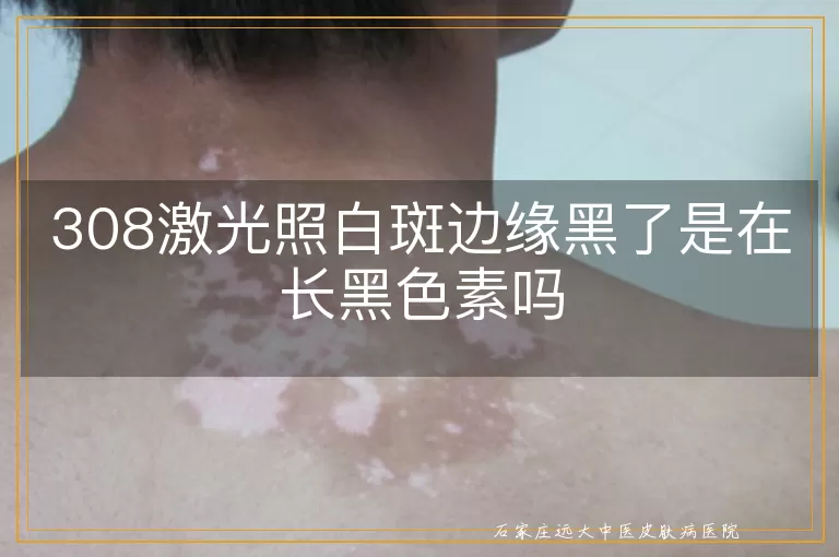 308激光照白斑边缘黑了是在长黑色素吗