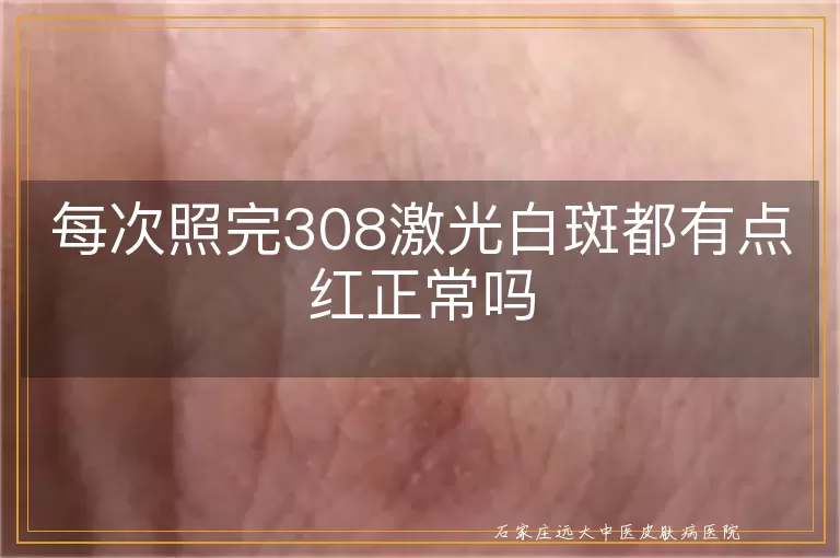 每次照完308激光白斑都有点红正常吗
