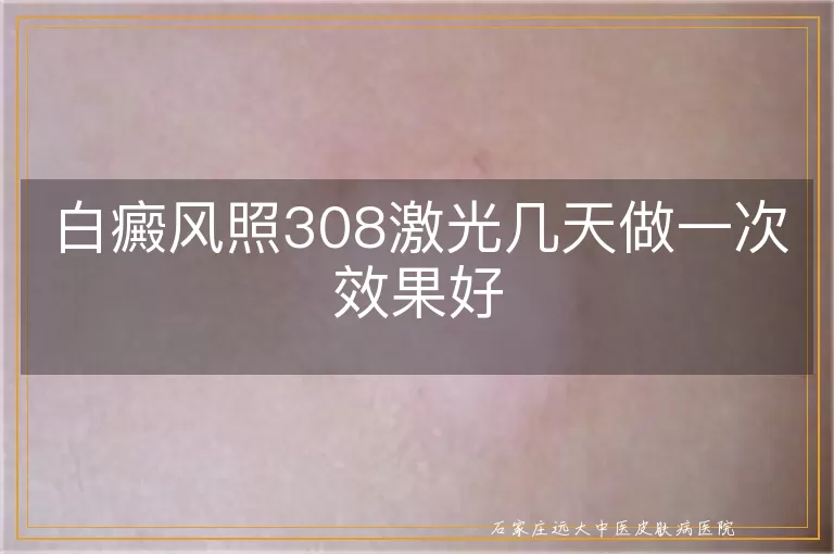 白癜风照308激光几天做一次效果好