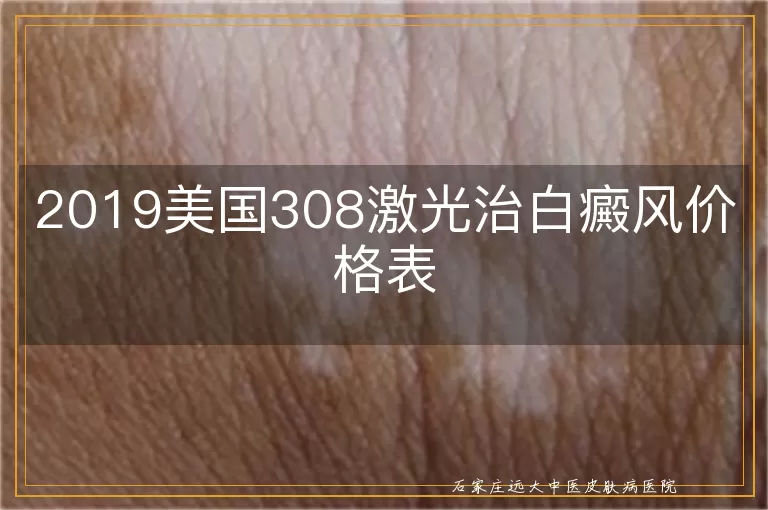 2019美国308激光治白癜风价格表