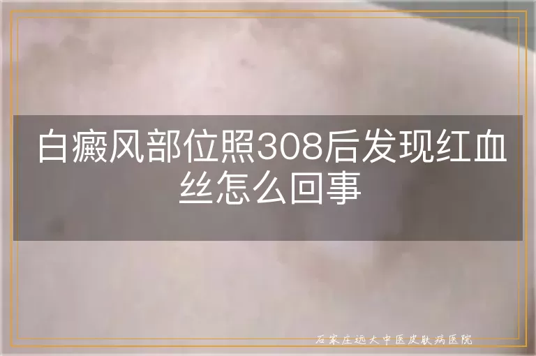 白癜风部位照308后发现红血丝怎么回事
