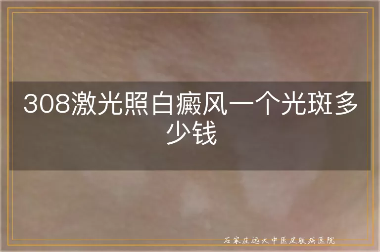 308激光照白癜风一个光斑多少钱