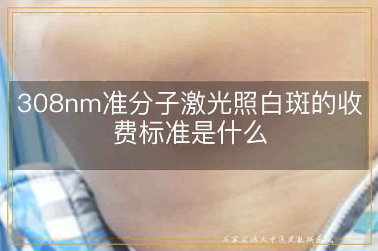 308nm准分子激光照白斑的收费标准是什么